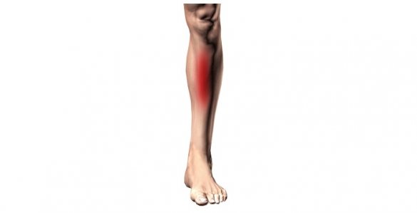 Illustration of leg with red area indicating pain caused by shin splints